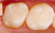 Cerec restaurierte Zähne