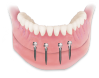 Mini-Implantate zur Prothesenstabilisierung